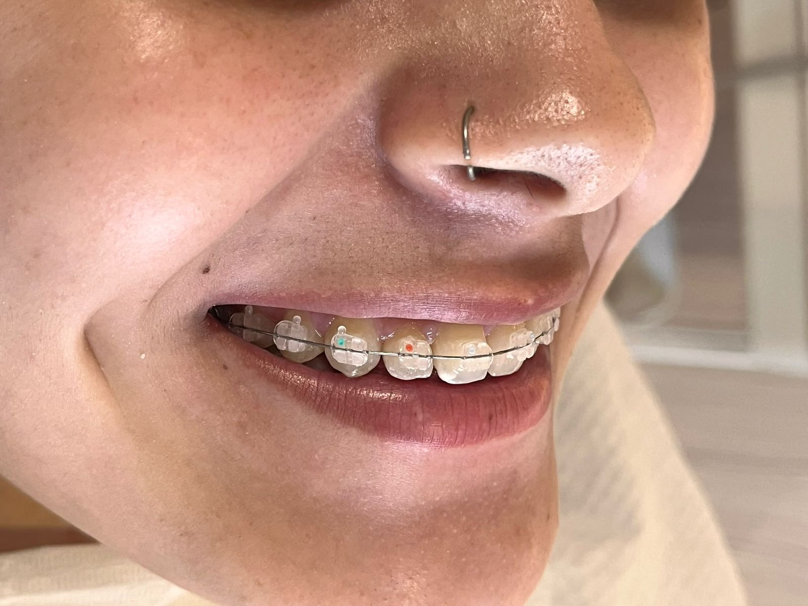 Sorriso saudável alinhado